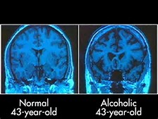 Efects of alcohol on brain